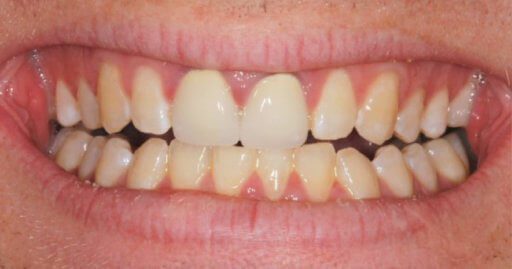 Teeth-2-Before Teeth-2-Before